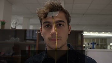 ABR WITH EVOCORTI STEP BY STEP