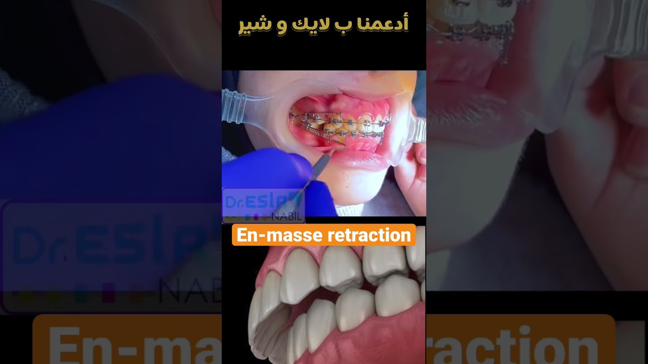 Orthodontic space closure | En-masse retraction