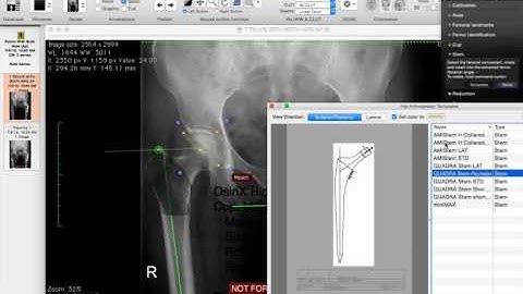 THR planning  using Planning Software -  Osirix