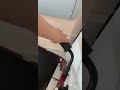 7-й день после эндопротезирование тазобедренного сустава 1406 2023