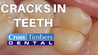 Cracks in teeth & what to do about them