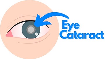 Eye Cataract explained with Animations