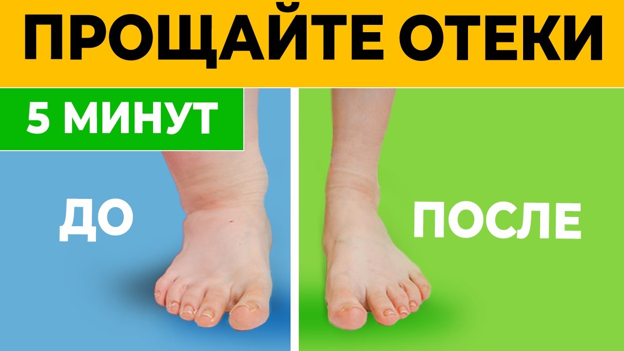 Как снять отеки без таблеток Быстрая практика от ОТЁКОВ. Отёки УБИВАЮТ наш организм! Упражнения от ОТЁЧНОСТИ 