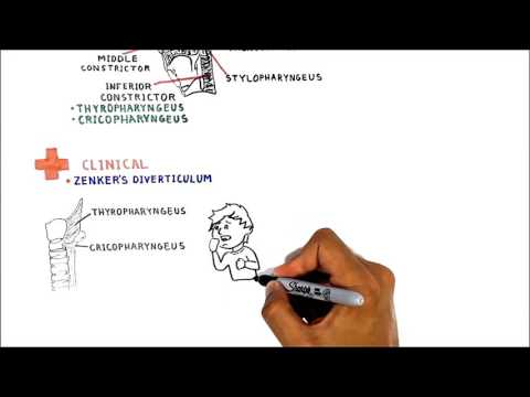 Video: „Zenker's Diverticulum“: Simptomai, Chirurgija, Priežastys