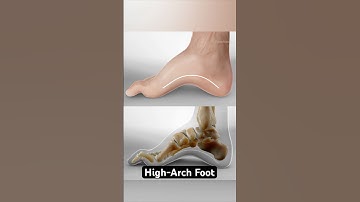 The shape of your foot could be causing your pain (3D Animation)