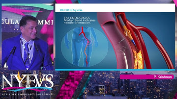 Percutaneous Transmural Arterial Bypass (PTAB) Alternative to Surgical Bypass - Dr. Prakash Krishnan