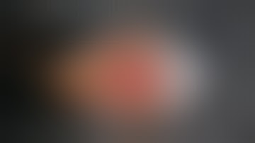 The Split Deltoid Approach For Proximal Humerus Platting