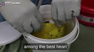 First in Israel: Rare Cardio Procedure at Sheba Where a New Heart Replaced an Artificial Device