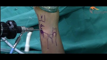 Arthroscpic TFCC Repair