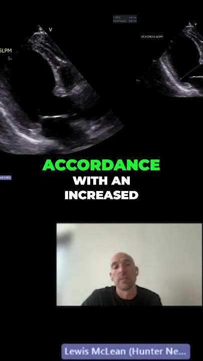 Understanding Contractile Reserve  Heart Function Insights #echo #echofirst #echonepean