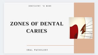 DENTAL CARIES ZONES