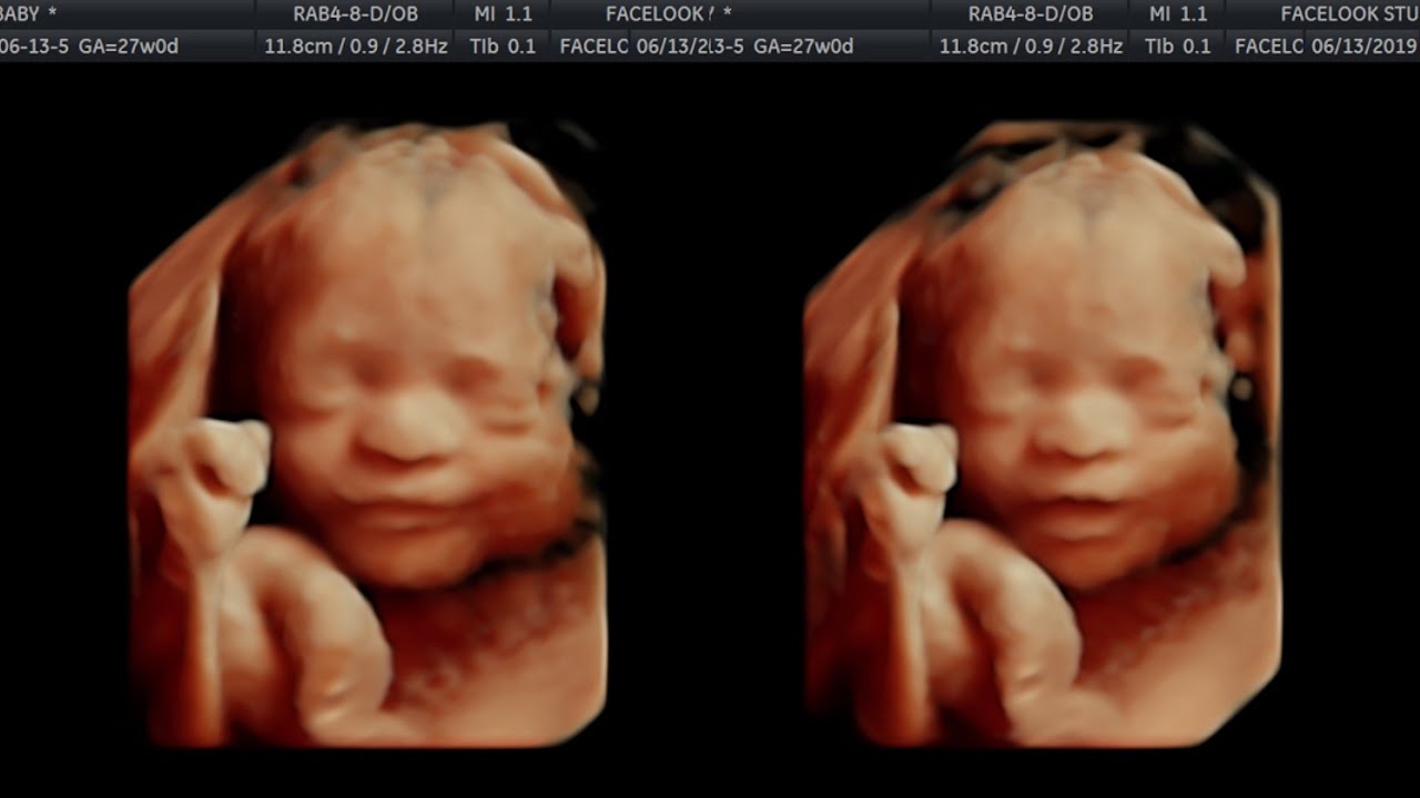 baby 4d ultrasound