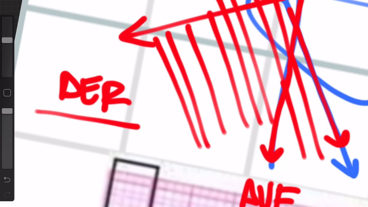 Lectura de un ECG: Bloqueo de rama izquierda vs derecha