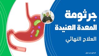 علاج جرثومة المعده السحري خطوات عملية تخلصك من التهاب المعدة وقرحة المعدة ستخرج جرثومة المعدة للأبد