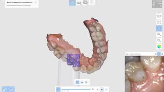 3D сканирование зубов в ИмиджСтоматология