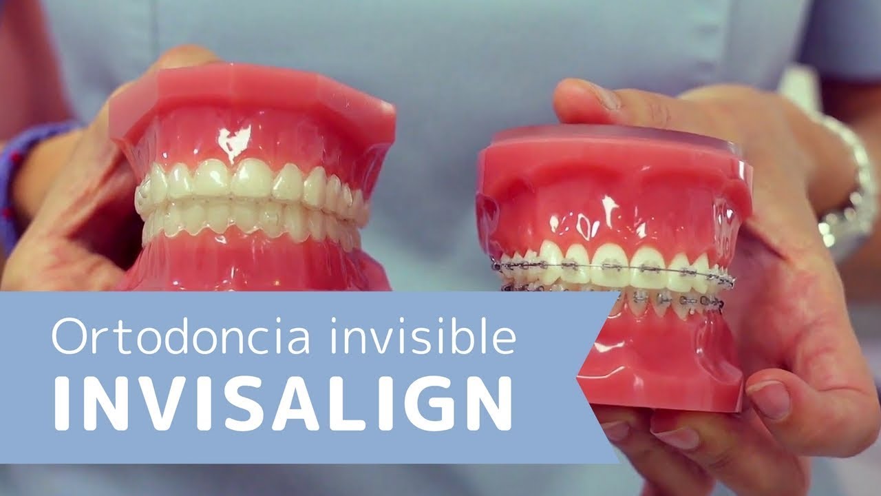 Cómo funciona la ortodoncia invisible o Invisalign? Resolvemos tus dudas de  este tratamiento dental 