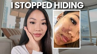 Download Lagu Herstel van ernstige hyperpigmentatie en wat mij daadwerkelijk geholpen heeft bij mijn genezing. MP3