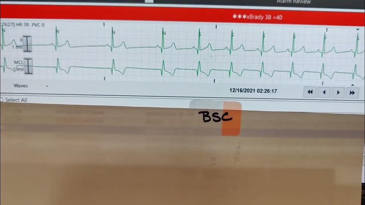 EKG Review Sinus Tachy with a Run of PVC's and Review Sick Sinus