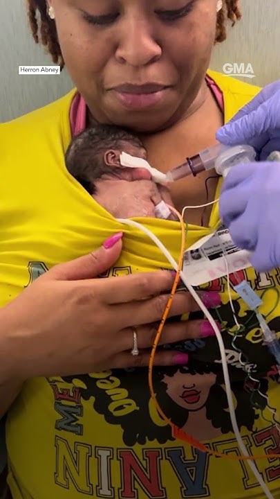 baby-born-weighing-less-than-1-pound-celebrates-1st-birthday-youtube