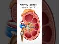 What Causes Kidney Stones mp3