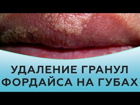 Видео: Белые шишки на губах: причины, методы лечения и многое другое