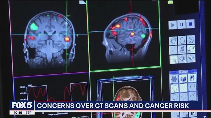 Concerns over CT scans and cancer risk
