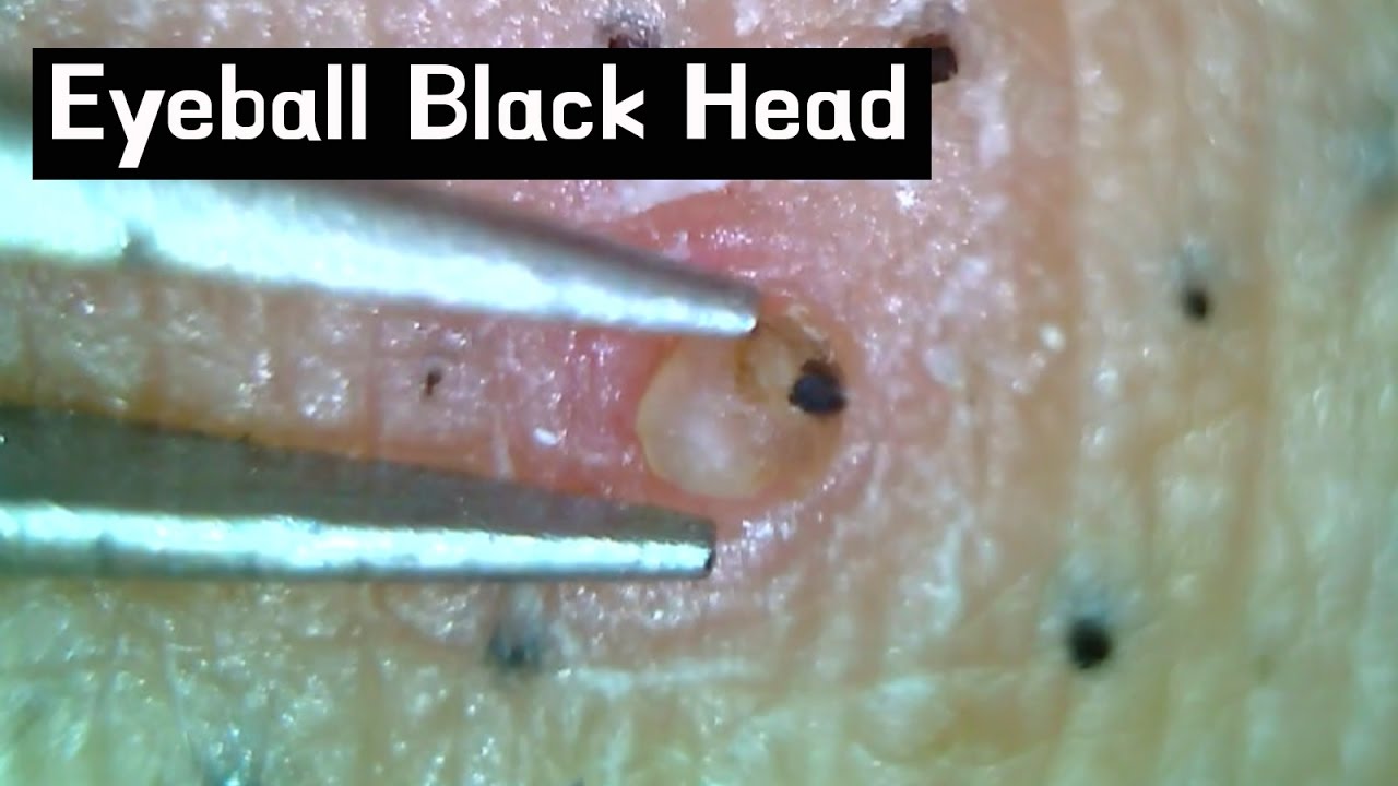 14 Pull Out Eyeball Blackheads Whiteheads Close Up 300x Blackheads