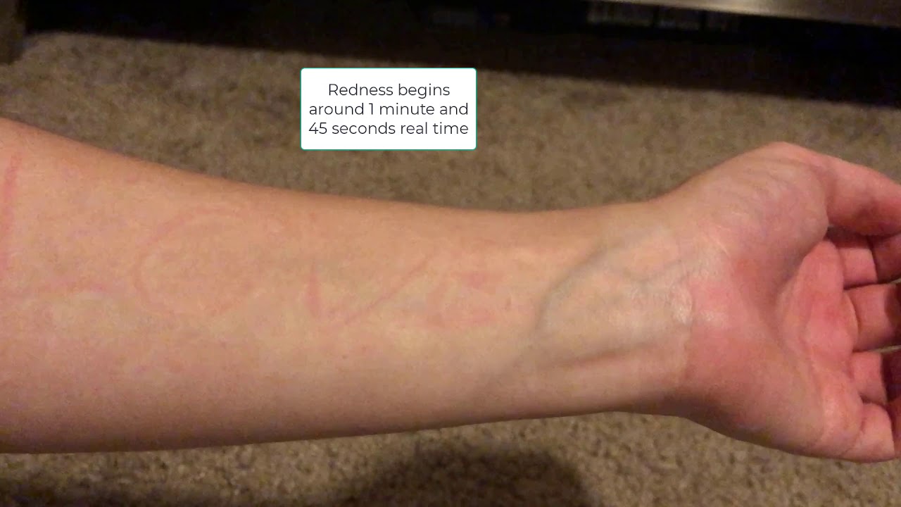Dermatographia Skin Writing Disease Timelapse Shorts Youtube