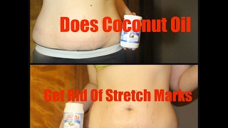 Does Coconut Oil reduce your stretch marks?