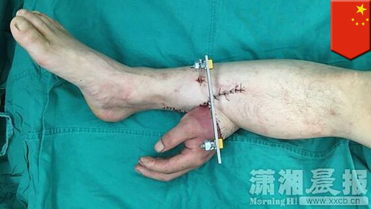 หมอจีนอัจฉริยะ ช่วยชายมือขาดด้วยการเอามือติดไว้ที่ขา