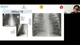 Management of Pediatric Tuberculosis, Dr  Anita, Neonatology, SGPGIMS,Lucknow 28 March 2024