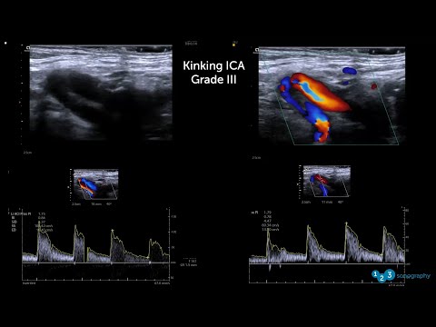 Image of Spring Ultrasound Knowledge Booster #7: Twists and Turns in Carotid Ultrasound