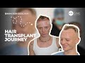 Bimini-Bon-Boulash&#39;s Hair Transplant at KSL Clinic
