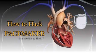 Famous How to Hack Pacemaker || Is it Possible to hack || By Tharun || #Logic_behind Net Worth