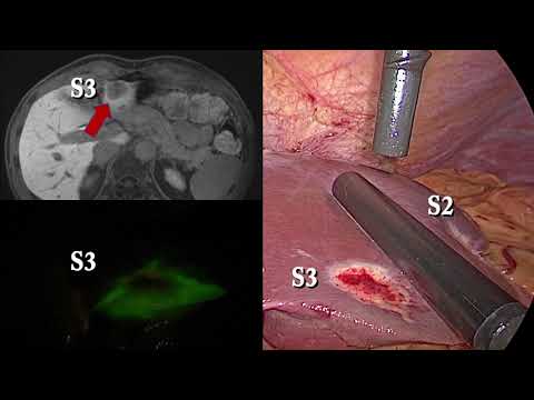 ONE STAGE LAPAROSCOPIC ICG GUIDED LIVER RESECTION FOR BILATERAL COLORECTAL LIVER METASTASES