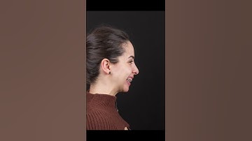 This lady wanted to correct her gummy smile together with mandible retrusion