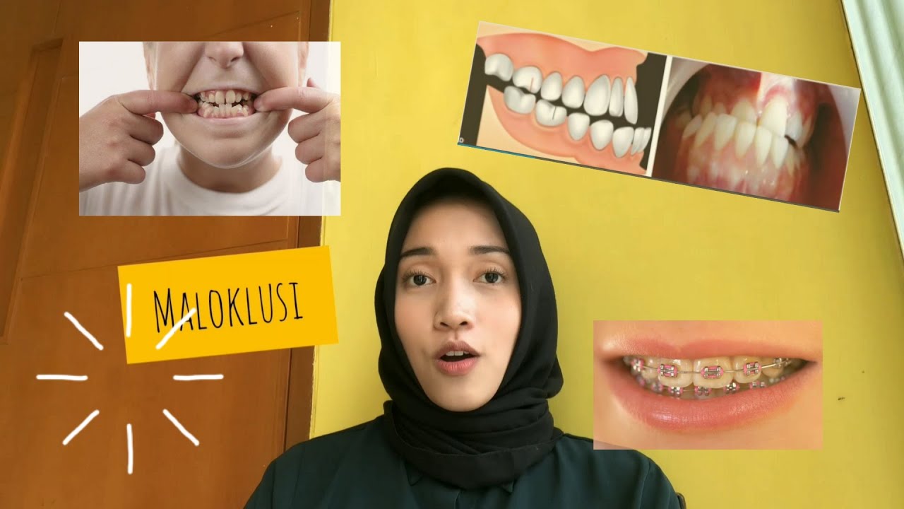 GIGI GAK RAPI/MALOKLUSI?! Bisa diperbaiki gak yah? Yukk kenali penyebab ...