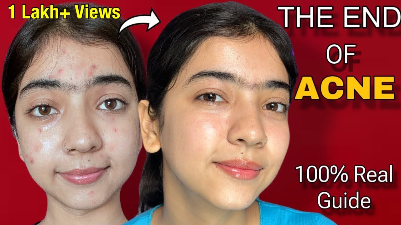 This is how you can Permanently Cure Acne| 100% Real| Acne treatment ...