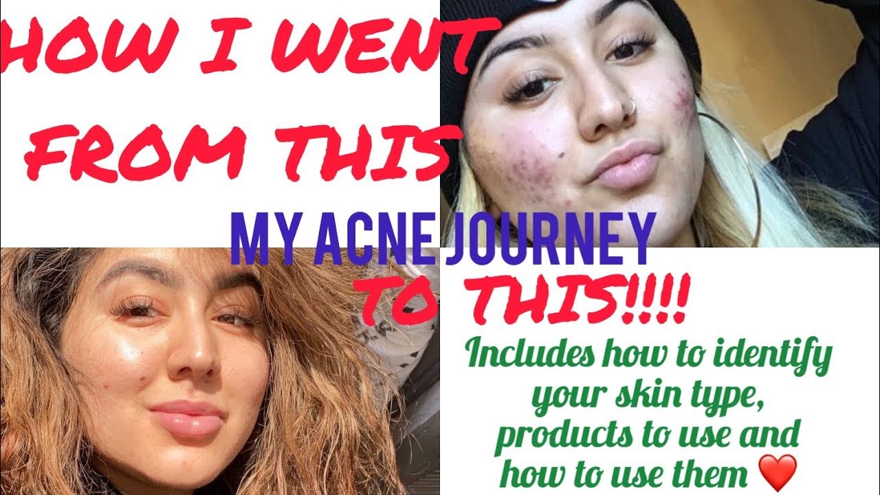 MY ACNE JOURNEY AND HOW I FIXED MY ACNE! (full details) - YouTube