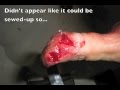 Thumb meets table saw. Thumb meets table saw.