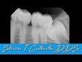 Extracting Impacted Wisdom Teeth - Dental Minute with Steven T. Cutbirth, DDS