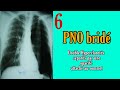 Telethorax 6  pno brid  syndrome pleural  hyperclaret en bande