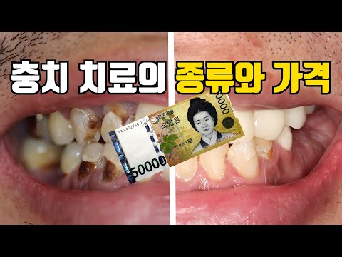   충치 치료의 종류와 가격 완벽하게 정리합니다