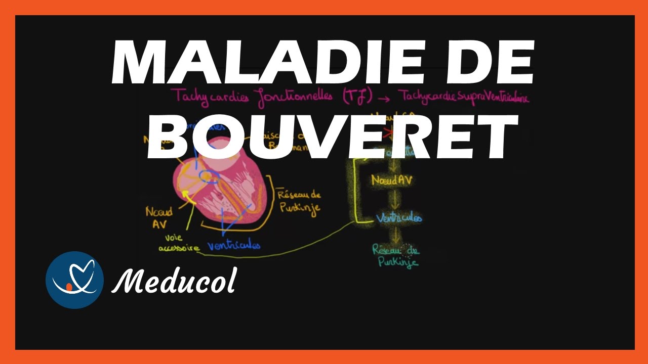 Tachycardie de Bouveret (Tachycardie Jonctionnelle) causes, symptômes — free download