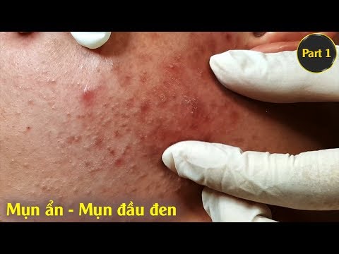 Điều trị mụn ẩn - mụn đầu đen hiệu quả uy tín. Tại Hiền Vân Spa |Part 1| bài 197