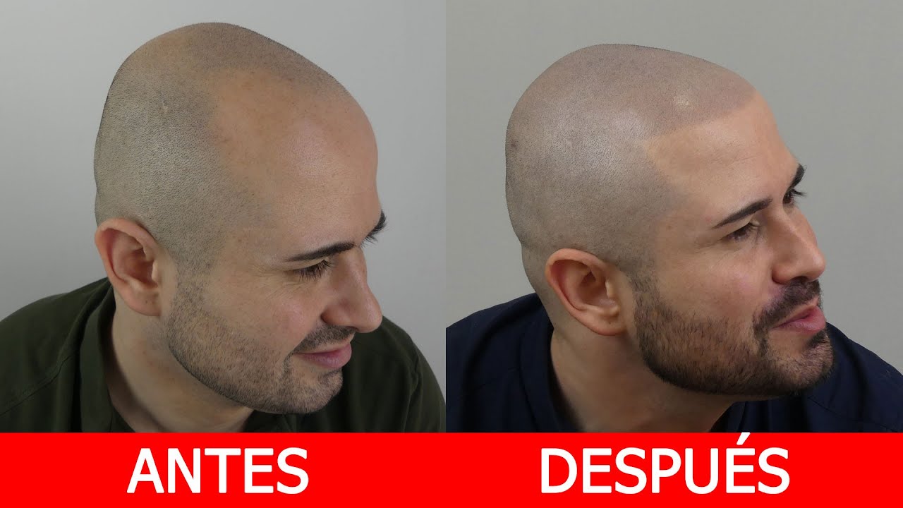 Antes y después de Micropigmentación Capilar. MDCC Hair Clinic YouTube