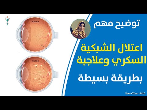 اعتلال الشبكية السكري - العلاج قد يجنب العمى ا الأسباب والأعراض والتشخيص والعلاج