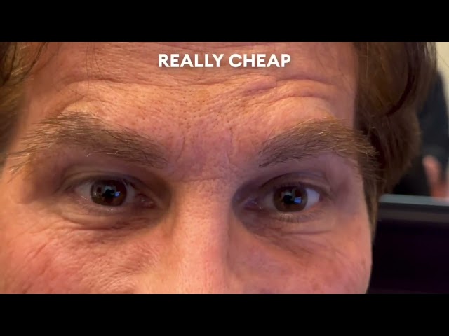 Dallas Male Eyebrow Transplant Testimonial with Before & After Photos