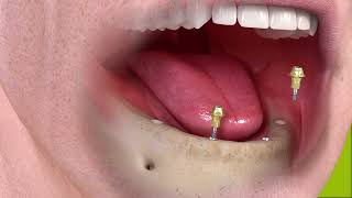 Fixed With 4 Implants, Tilted Posterior Coastal Carolina Oral Surgery