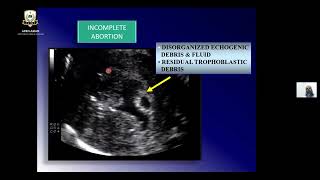 Ultrasound for Differential Diagnosis of Abortions | @afroasianims